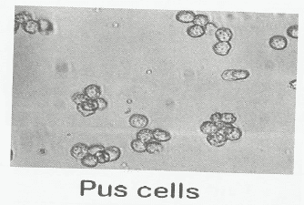 الفحص الميكروسكوبي لعينات البول : خلايا الصديد