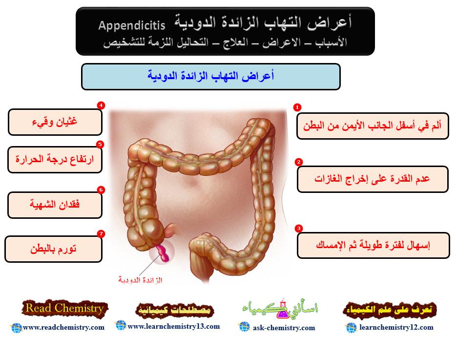 إلتهاب الزائدة الدودية Appendicitis – الأسباب الأعراض العلاج