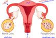 متلازمة المبيض المتعدد الكيسات Poly cystic ovary