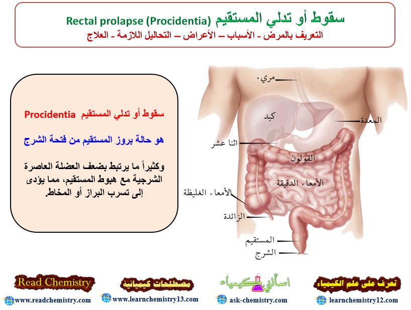 سقوط أو تدلي المستقيم Rectal prolapse (Procidentia)