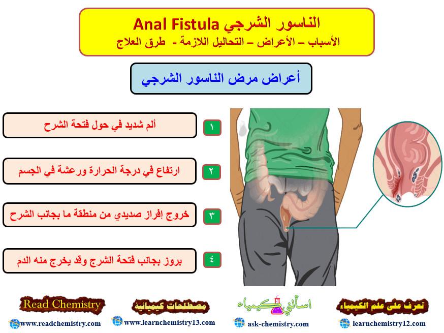 الناسور الشرجي Anal Fistula – الأسباب الأعراض العلاج