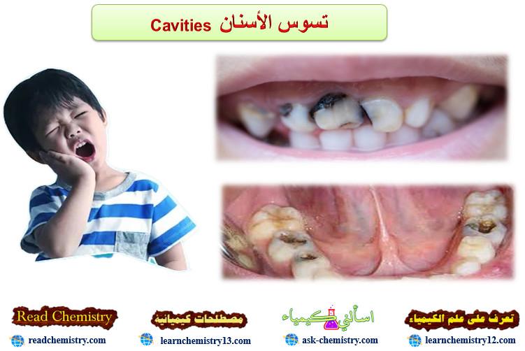 تسوس الأسنان Cavities الأسباب الأعراض العلاج