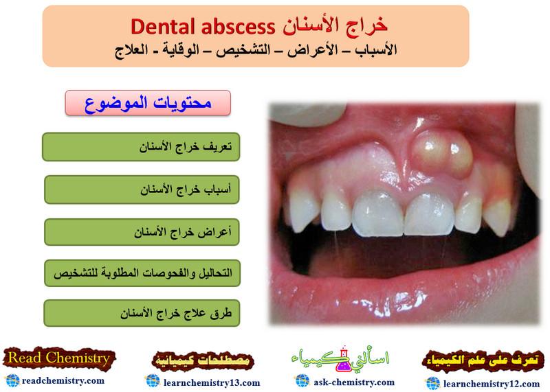 خراج الأسنان Dental abscess