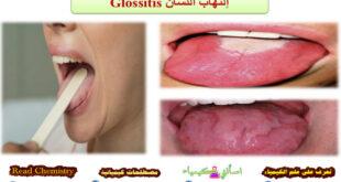 إلتهاب اللسان (Glossitis (tongue Inflammation