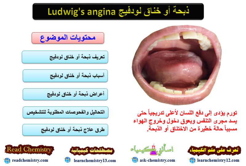 ذبحة أو خناق لودفيج Ludwig's angina