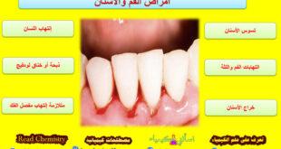 أشهر أمراض الفم والأسنان