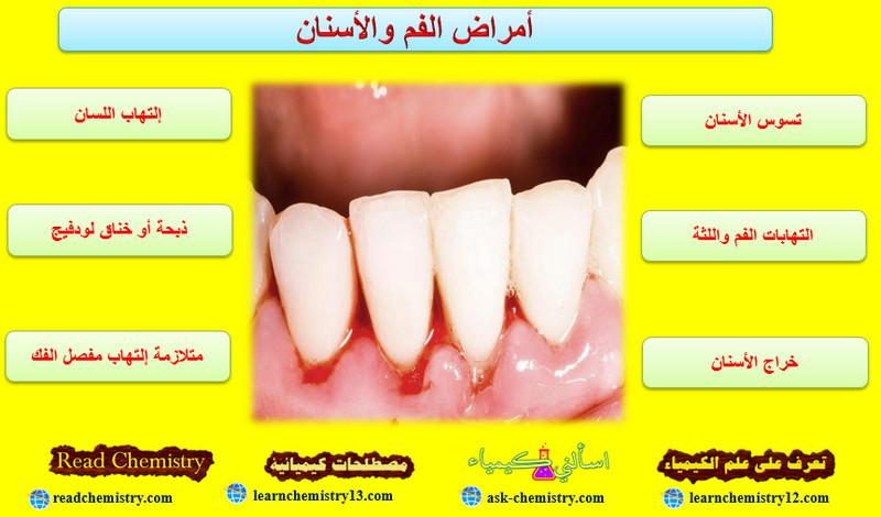 أشهر أمراض الفم والأسنان