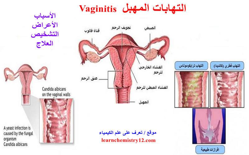 التهابات المهبل Vaginitis – الأسباب الأعراض العلاج