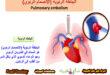 الجلطة الرئوية (الإنصمام الرئوي) Pulmonary embolism