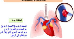 الجلطة الرئوية (الإنصمام الرئوي) Pulmonary embolism