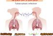 الدرن أو السل الرئوي مرض يقل 2 مليون إنسان سنوياً