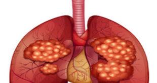 سرطان الرئة Lung cancer - الأسباب الأعراض العلاج