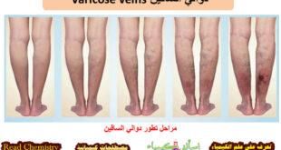 دوالي الساقين Varicose veins – الأسباب الأعراض العلاج