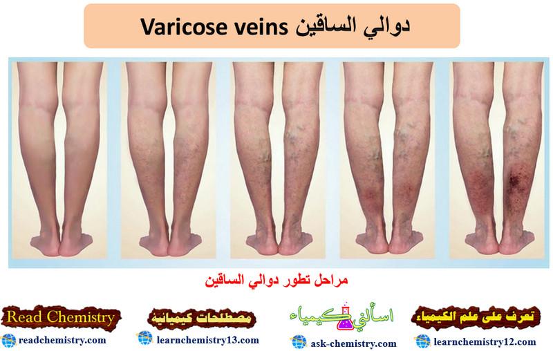 دوالي الساقين Varicose veins – الأسباب الأعراض العلاج