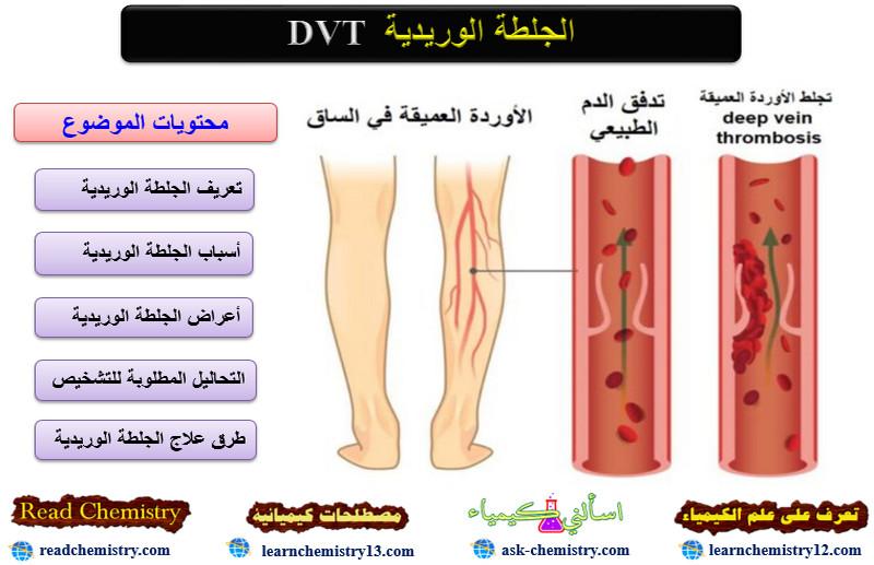 الجلطة الوريدية DVT – الأسباب الأعراض العلاج