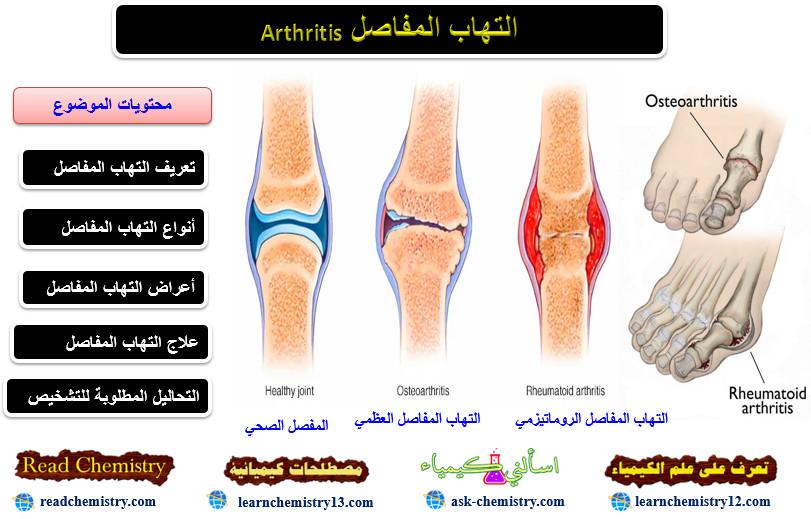 التهاب المفاصل Arthritis الأعراض والعلاج