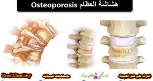 هشاشة العظام Osteoporosis - الأسباب الأعراض العلاج