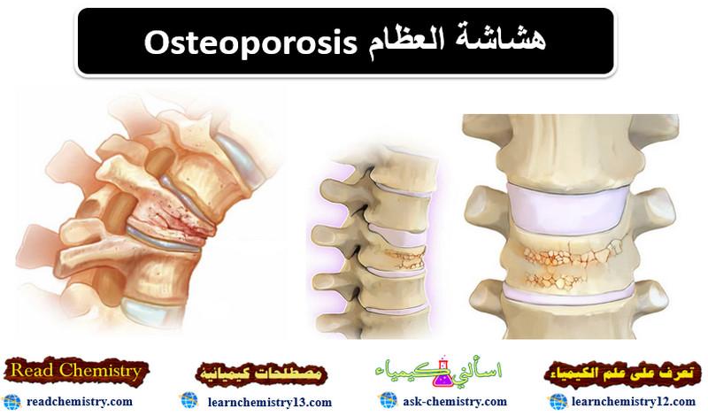 هشاشة العظام Osteoporosis - الأسباب الأعراض العلاج