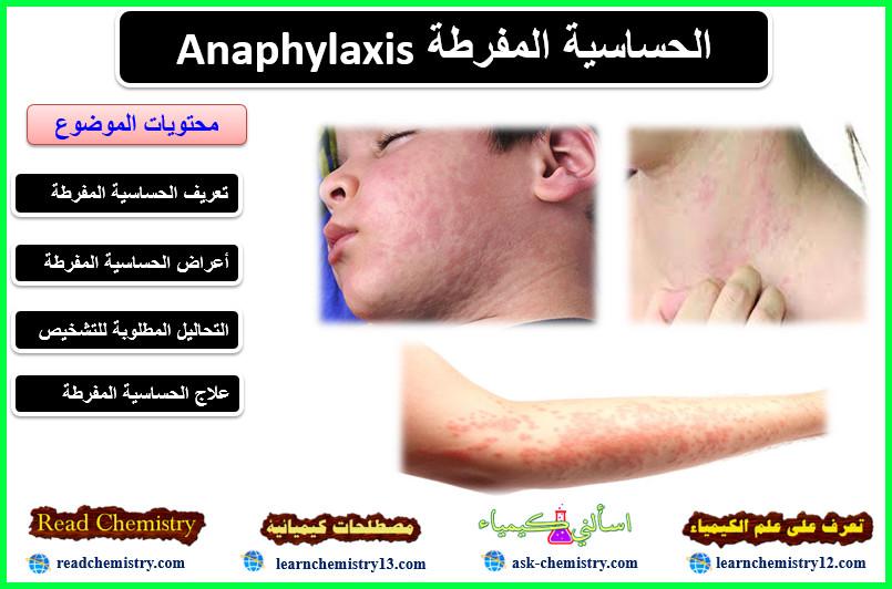 الحساسية المفرطة Anaphylaxis الأعراض العلاج
