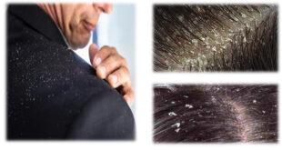 قشرة الشعر Dandruff – الأسباب الأعراض العلاج