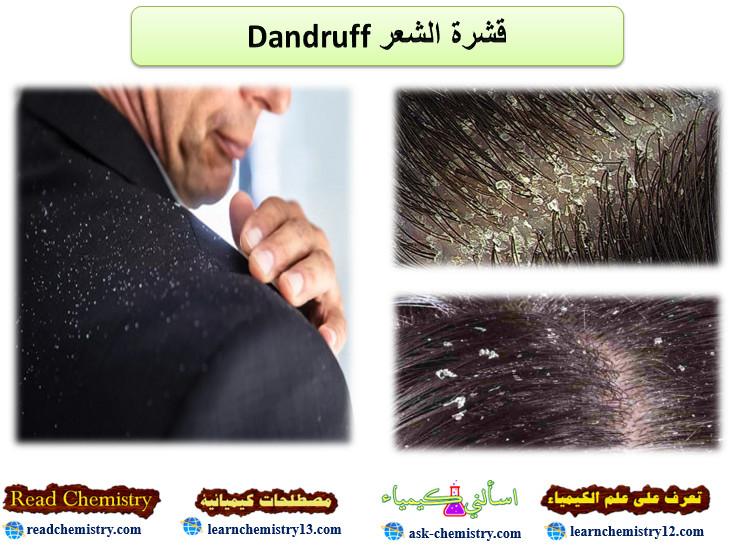 قشرة الشعر Dandruff – الأسباب الأعراض العلاج