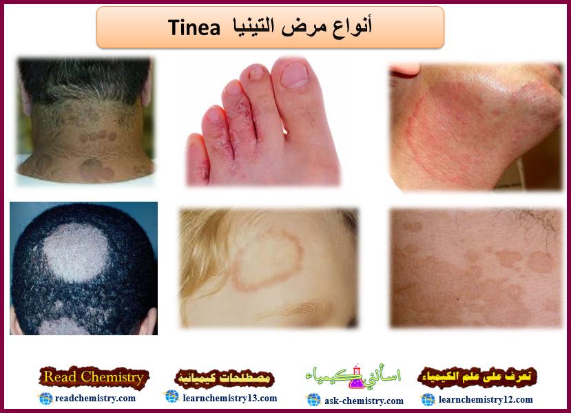 مرض التينيا Tinea – الأسباب الأعراض العلاج