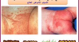 الطفح الجلدي من الحفاض - الأعراض العلاج
