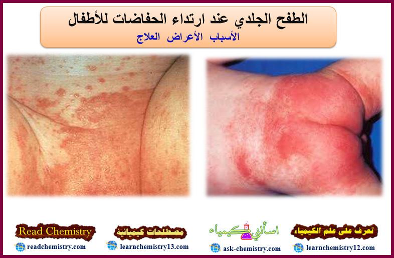 الطفح الجلدي من الحفاض - الأعراض العلاج