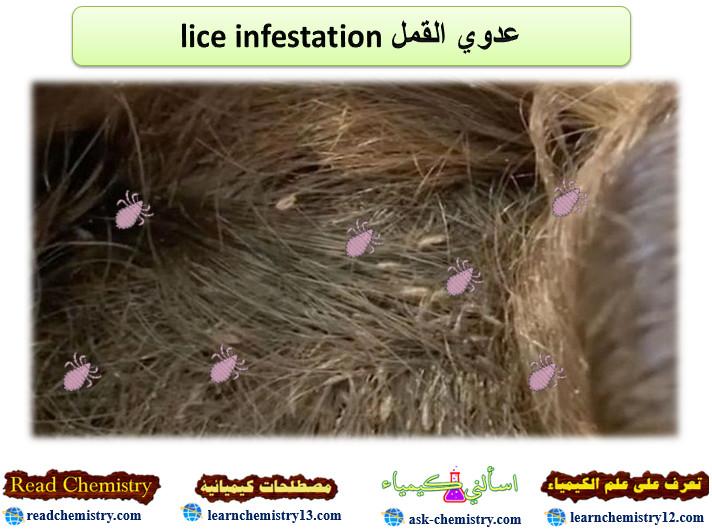 عدوى القمل – حشرة القمل lice infestation