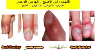 التهاب رأس الأصبع – الهربس الداحس