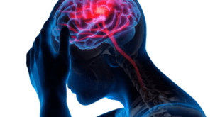 السكتة الدماغية Stroke – الأسباب - الأعراض - العلاج