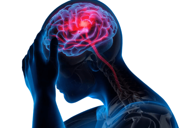 السكتة الدماغية Stroke – الأسباب - الأعراض - العلاج