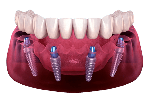 جراحة زراعة الأسنان التعويضية