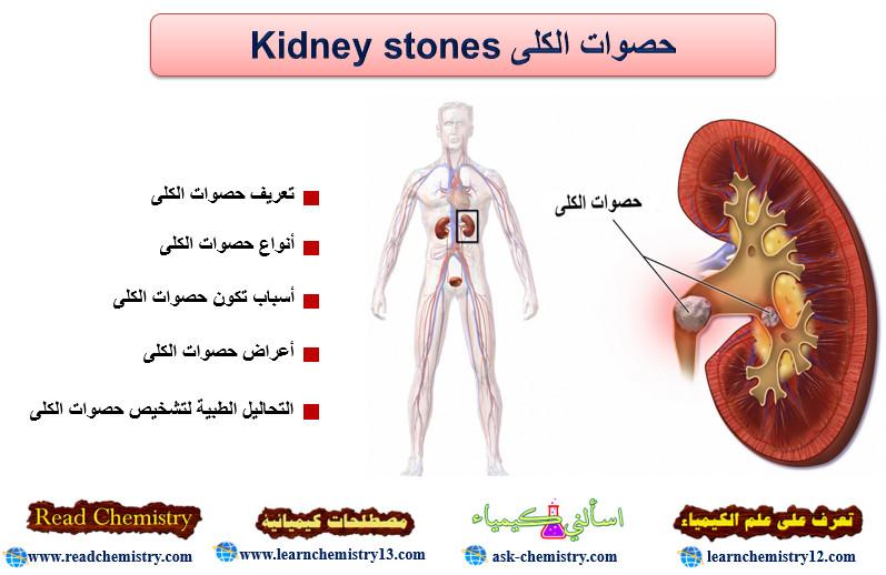 حصوات الكلى Kidney stones – الأسباب - الأعراض - العلاج