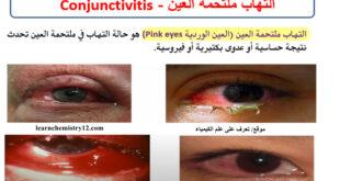 التهاب ملتحمة العين - العين الوردية Conjunctivitis