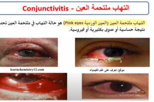 التهاب ملتحمة العين - العين الوردية Conjunctivitis